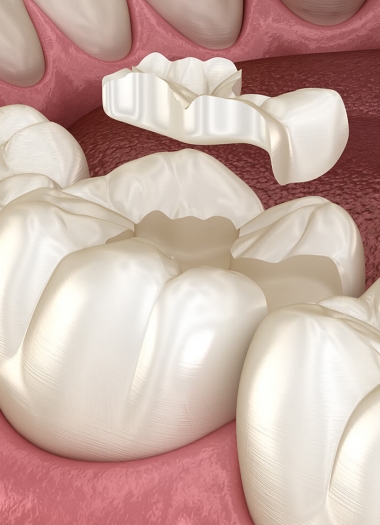 3D齒雕——銀粉崩落、二次蛀牙
