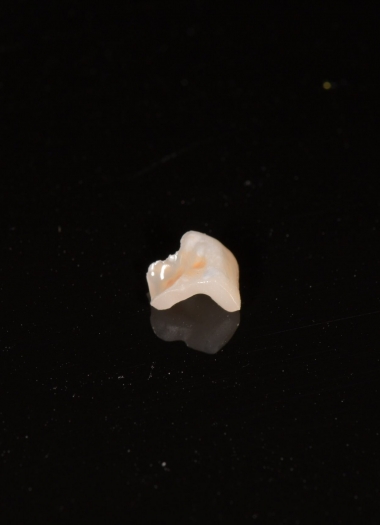 3D齒雕——舊樹脂填補物崩落
