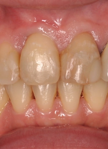 牙根覆蓋術——多處牙齦萎縮、牙根暴露