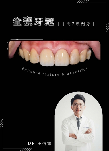 全瓷冠