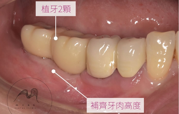 補牙肉手術拯救牙齦萎縮 提升植牙成功率